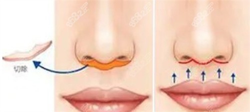 深圳福雅胡俊杰人中很膩害嗎？技術(shù)+價(jià)格+疤痕+改善全揭秘！