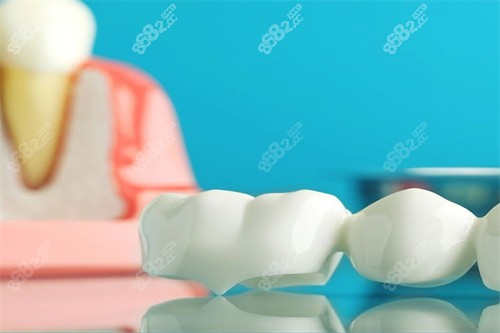 牙齒治療材料圖