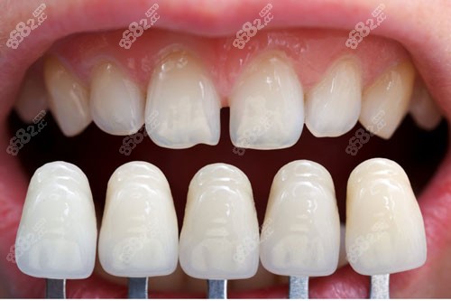 牙齒貼面顏色對比圖