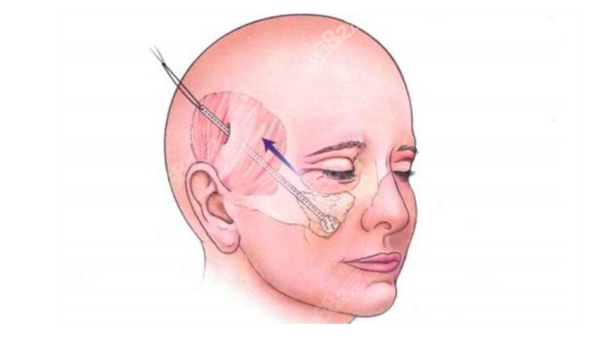 黃寅守醫(yī)生拉皮手術(shù)為什么那么貴？深度解析黃寅守面部提升及剝離層次