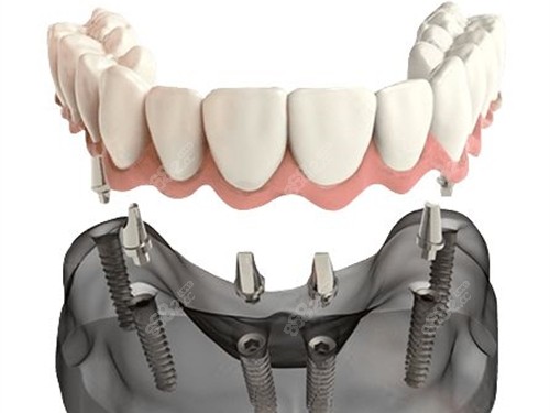半口種植牙聯(lián)排牙冠安裝示意圖