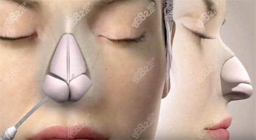 隆鼻手術(shù)動(dòng)畫圖