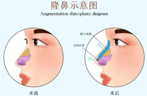 隆鼻前后對(duì)比