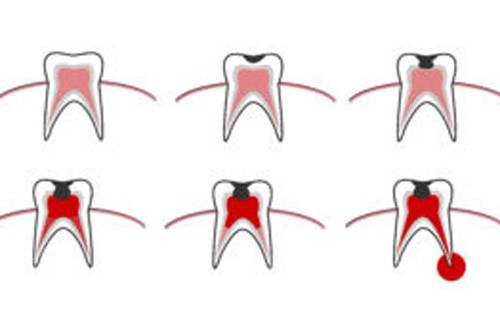 牙齒疼痛內(nèi)部示意圖