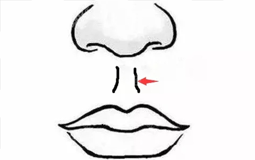 人中縮短術(shù)部位展示