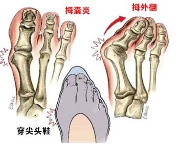 腳趾拇外翻卡通圖照片