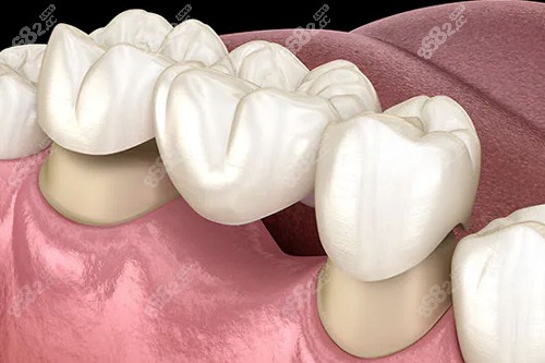 昆明安寧鑲牙去哪家好？美云/金色/李蒙口腔鑲牙口碑好，附各自優(yōu)勢(shì)特色