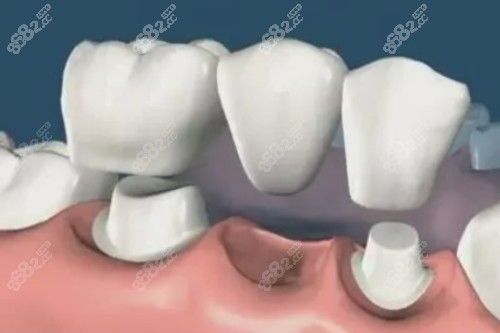 鑲牙卡通圖片一覽