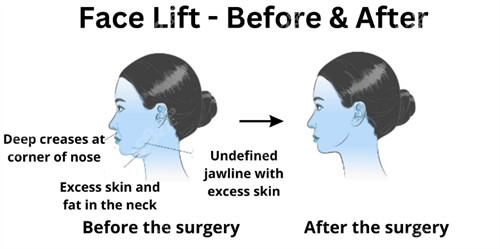 面部提升前后下巴及皮膚的改善對比