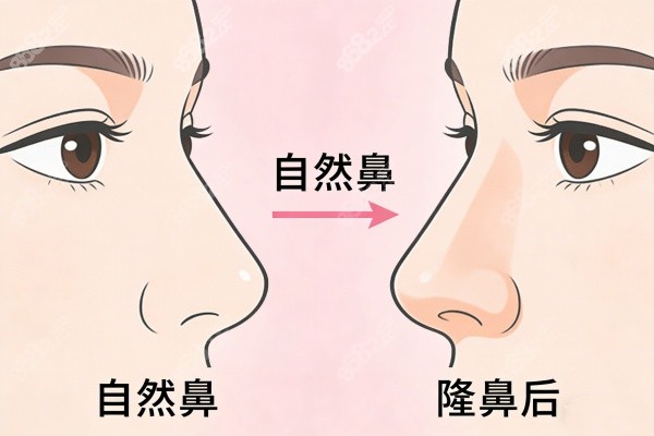 自然鼻型隆鼻前后對(duì)比圖