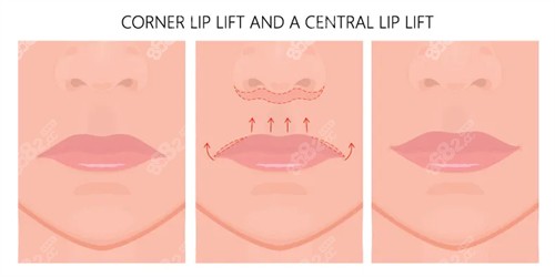 人中縮短手術(shù)動畫圖示