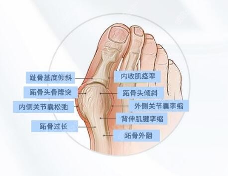 溫建民拇外翻手術(shù)成功幾率高嗎？解析溫氏小創(chuàng)口小切口矯正技術(shù)特色