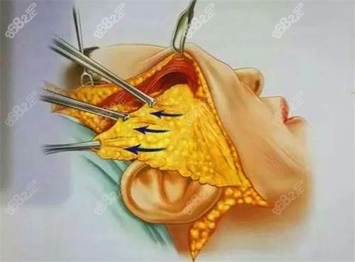 拉皮手術(shù)示意圖.jpg