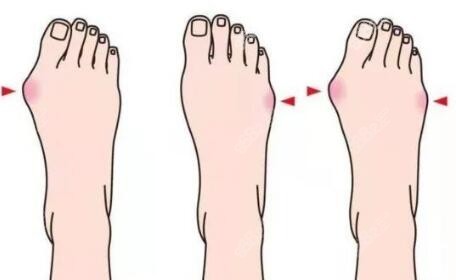 拇外翻卡通圖照片