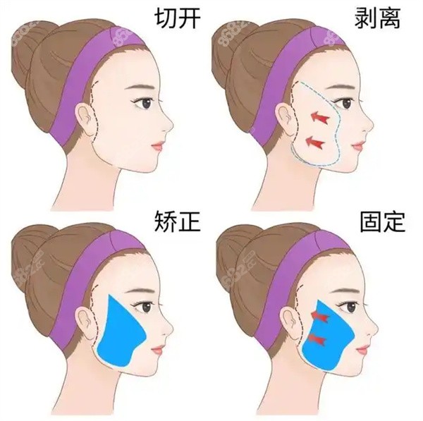 面部拉皮整形手術(shù)