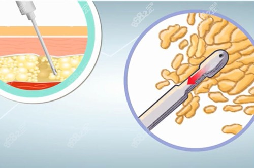 吸脂微觀示意圖