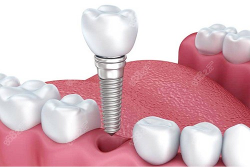 種植牙植入圖