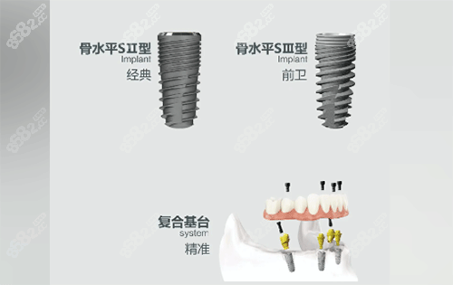 安聯(lián)種植牙用起來怎么樣