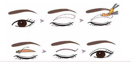 全切雙眼皮過(guò)程示意圖 全切雙眼皮過(guò)程示意圖