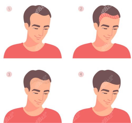 發(fā)際線植發(fā)前后圖解