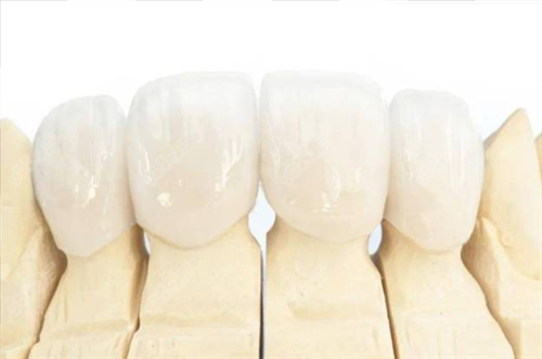 全瓷牙冠佩戴模型展示