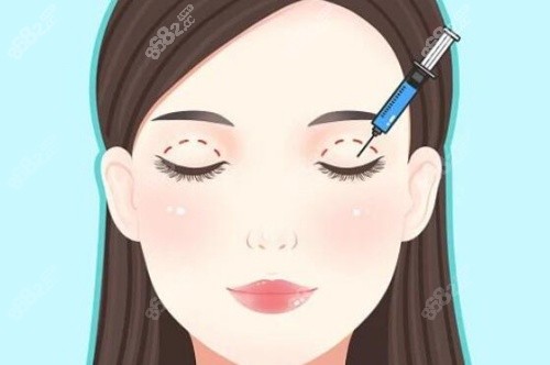 做雙眼皮示意圖 做雙眼皮示意圖