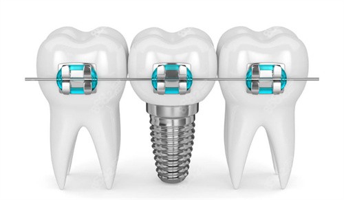 種植牙牙齒矯正圖片