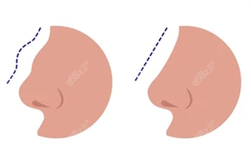 修復失敗鼻子前后對比圖