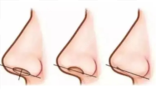 鼻小柱延長手術(shù)動(dòng)畫成效對比圖