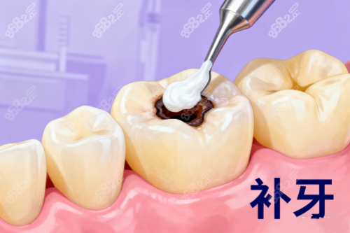 補(bǔ)牙卡通展示圖