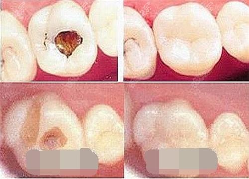 補(bǔ)牙前后展示圖