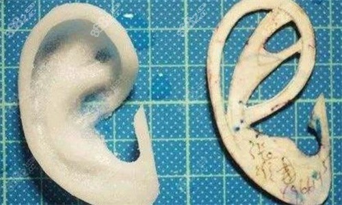 Medpor人工支架耳再造手術(shù)