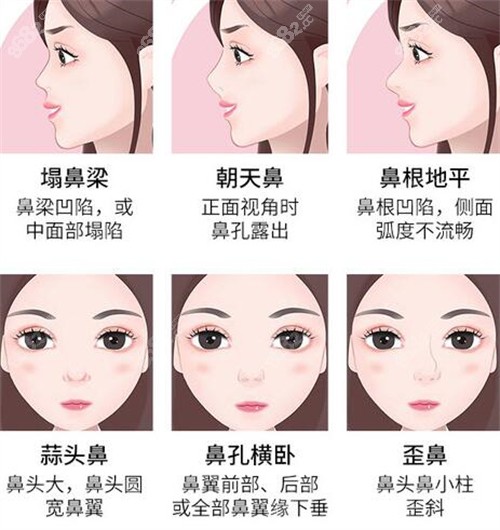 哪些鼻子需要做修復手術