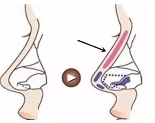 分段式隆鼻示意圖