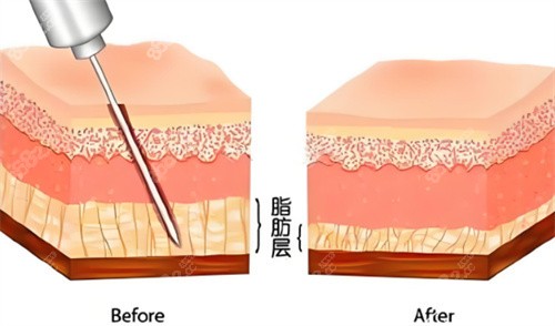 吸脂手術(shù)脂肪層對(duì)比