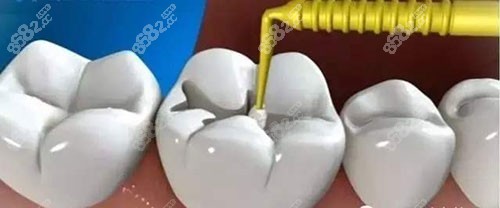 補(bǔ)牙治療過程示意圖