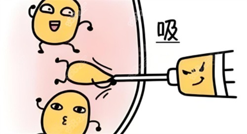 吸脂術(shù)動(dòng)畫