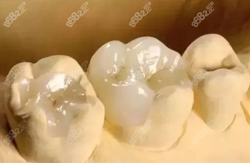 補(bǔ)牙模型展示圖