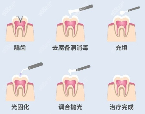 補(bǔ)牙步驟展示圖