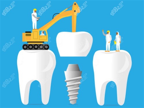 種植牙工程示意圖