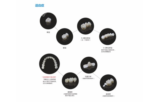氧化鋯魅影牙冠適應(yīng)癥圖