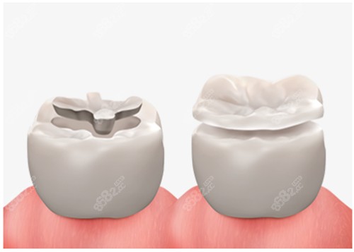 補(bǔ)牙動畫圖示