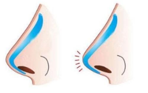 假體隆鼻示意圖
