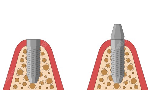 種植牙樁體展示