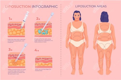 吸脂前后對(duì)比照