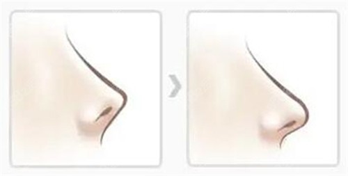 鼻子朝天矯正改善