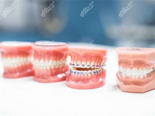 不同的牙齒矯正牙套模型