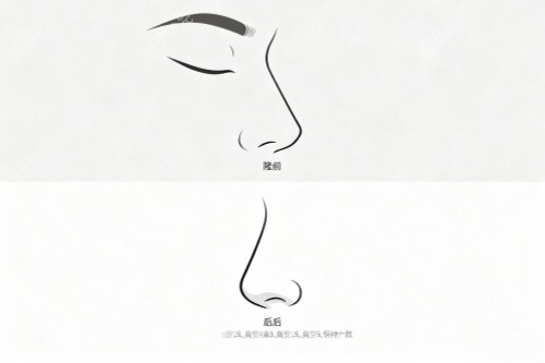 鼻子做整形前后對比圖