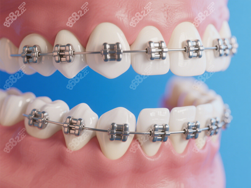金屬托槽牙齒矯正特寫