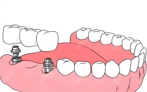 種植牙材料卡通展示圖